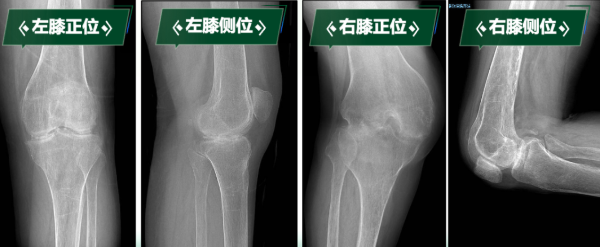 一條腿僵硬如棍 一條腿屈曲90° 如何破除“僵直”枷鎖