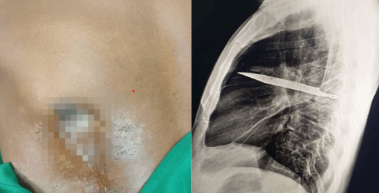 男子胸部流膿 X光發現刀留體內8年:剛好避開心臟血管